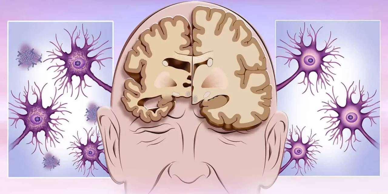 Sleep Disruption Accelerates Brain Aging: Breakthrough Research by Mohammad Sultan Khan